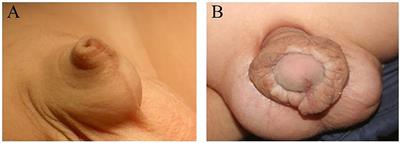 The Characteristics and Distribution of Nerve Plexuses in the Dartos Fascia From Concealed Penis Children